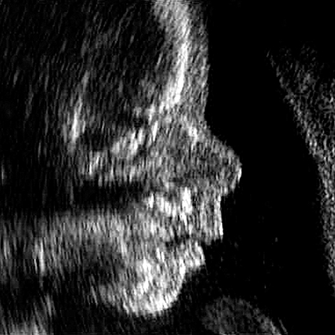 Fetal_face_profile